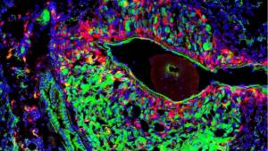 Tumor extracellular vesicles and particles promote metastasis and multi-organ disease