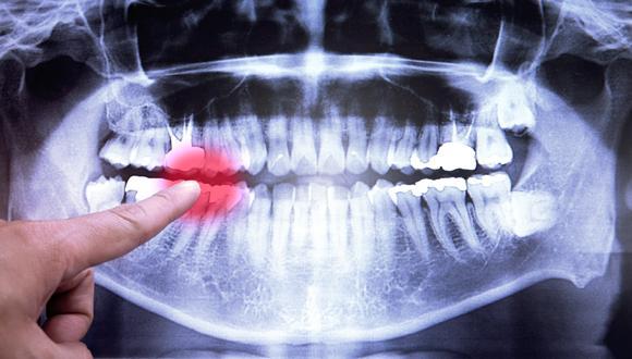 dental X-ray